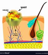 Image result for Plantar Wart Diagram