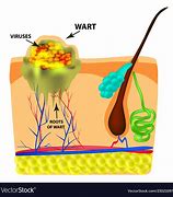 Image result for Plantar Wart