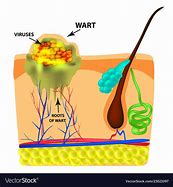 Image result for Plantar Wart Root
