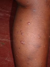 Image result for Molluscum Contagiosum On Dark Skin