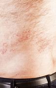 Image result for Shingles On Forearm