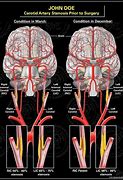 Image result for Stenosis of Carotid Artery