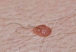 Image result for Moles Above-Knee