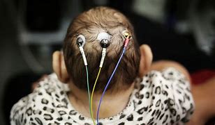 Image result for Microencephaly