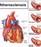 Image result for aterosclerosis