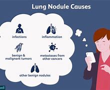Image result for What Are Nodules in the Lungs