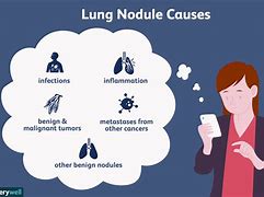 Image result for Right Lower Lung Nodules