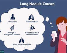 Image result for 12Mm Nodule in Lung