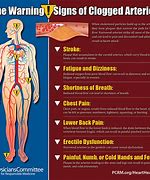 Image result for Clogged Artery in Neck