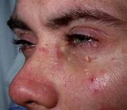 Image result for Contagious Molluscum Children Eye