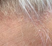 Image result for Dermatitis Eczema Seborrheic Contect