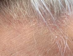 Image result for Eczema in Scalp