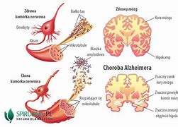 Image result for choroba_blounta