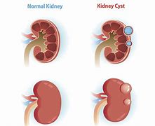 Image result for Renal Pelvis Cyst