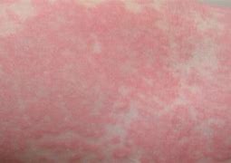 Image result for Skin Rash From Allergies