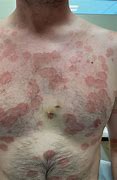 Image result for The Scariest Skin Eruptions