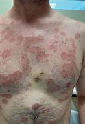 Image result for Skin Eruptions Clot