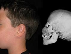 Image result for Jaw Bone Abnormality