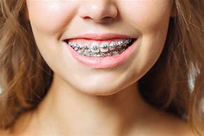 Image result for Smile Teeth with Braces