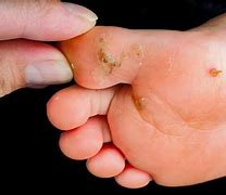 Image result for Infected Wart
