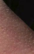Image result for Molluscum Contagiosum Early Stage
