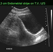 Image result for Dermoid Ultrasound