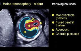 Image result for Fetal Holoprosencephaly