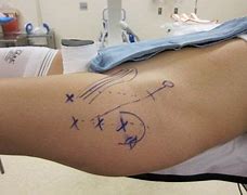 Image result for Recovery Time for Left Hip Surgery