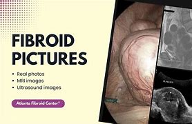 Image result for Real Fibroids