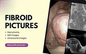 Image result for 5 cm fibroids ultrasound images