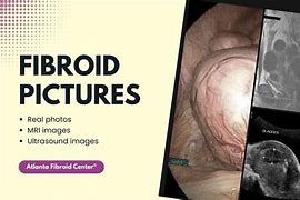 Image result for 9 Centimeter Fibroid