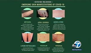Image result for Covid 19 Rash On Skin Symptoms