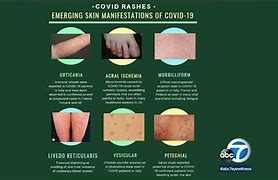 Image result for Viral Infection On Face