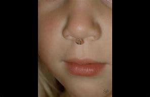 Image result for Filiform Wart On Nose
