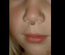 Image result for Filiform Wart Nose