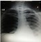 Image result for Uresil Pneumothorax Kit