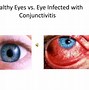 Image result for Allergic Conjunctivitis