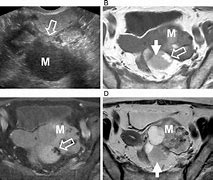 Image result for Multicystic Ovarian Mass