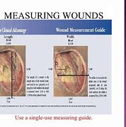Image result for Foot Wound Measurement