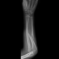 Image result for Monteggia Fracture