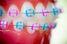 Image result for Byte Invisible Braces