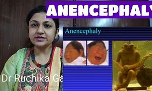 Image result for Anencephaly Disease