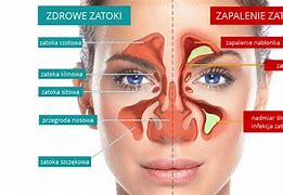 Image result for co_to_za_zderzenie_czołowe