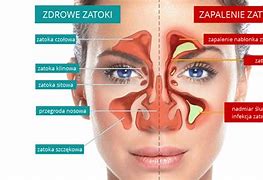 Image result for co_oznacza_zatoki_szczękowe