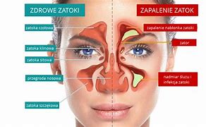 Image result for co_to_za_zatoki_oboczne_nosa