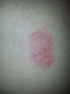Image result for Itchy Burning Bumps On Skin