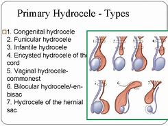 Image result for hidrocele
