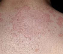 Image result for Body Skin Rash Ringworm