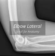 Image result for Lateral View of Elbow X-ray Labeled