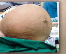 Image result for Large Fibroid Removal